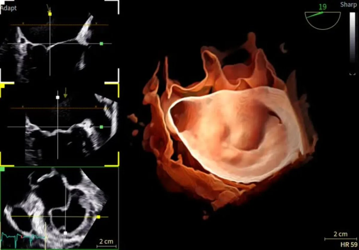 Alta tecnologia in cardiologia: l’Ospedale di Perugia si dota del GE Vivid Pioneer, ecocardiografo 4D di ultima generazione