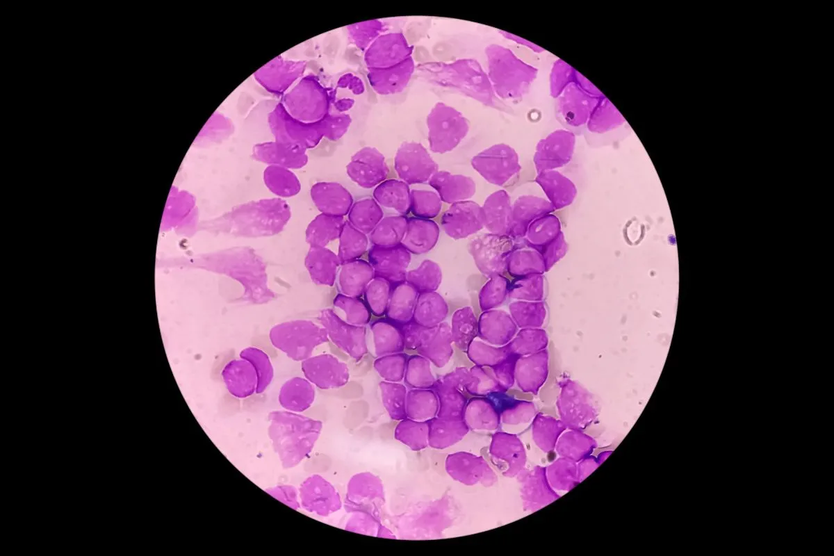 Leucemia, nuova scoperta dei ricercatori di Perugia: identificata una forma acuta linfoblastica T con firma genetica distintiva